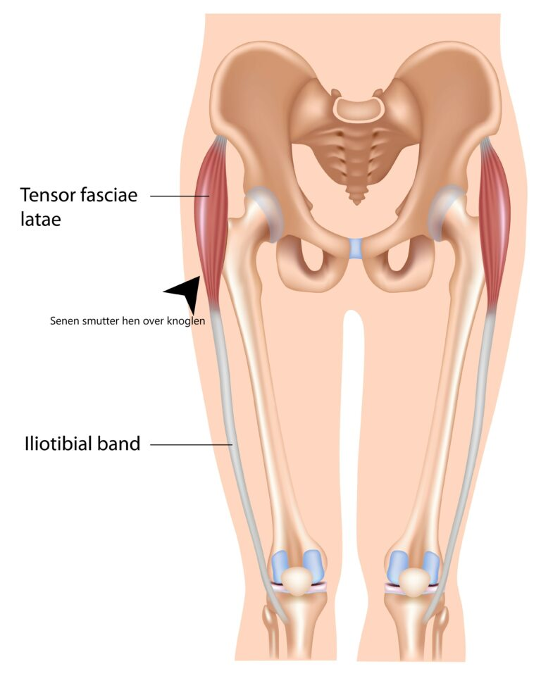 Senen på ydersiden af hoften kan smutte hen over knoglen og give udvendig springhofte
