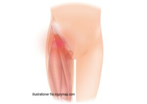Intern springhofte er typisk hoftebøjeren der smutter hen over knoglen i lyskeregionen