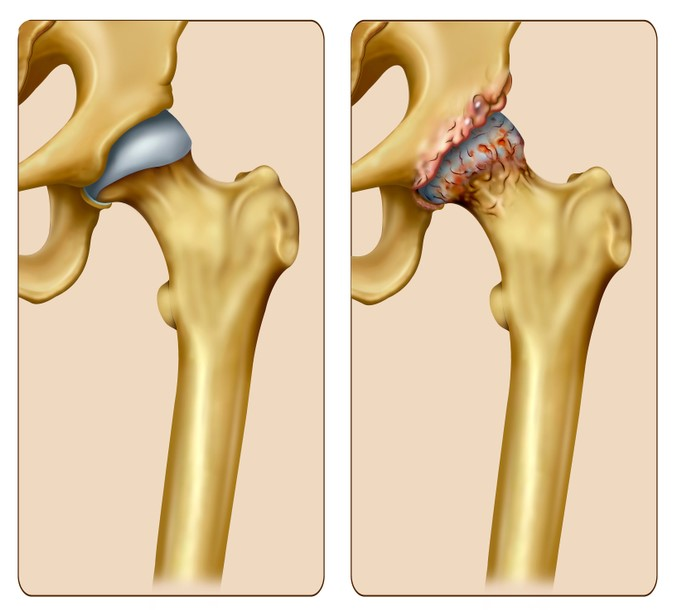 Et billede af et rask hofteled og et der viser slidgigt i hoften
