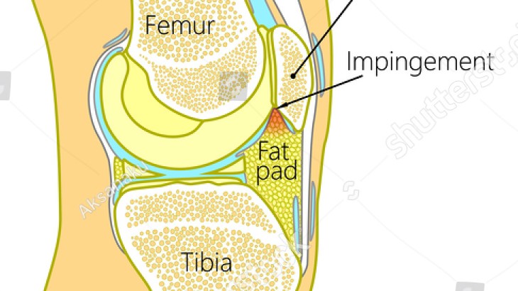 Ofte er det fedtpuden foran i knæet der giver forreste knæsmerter når den kommer i klemme.