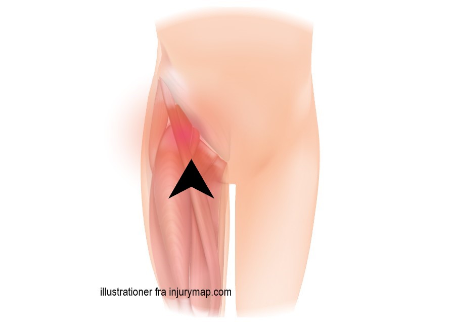 Skader i hofte og lyske